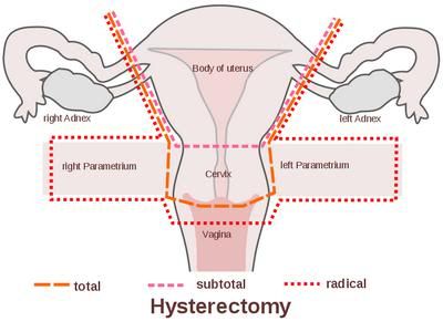 Sketsa Histerektomi